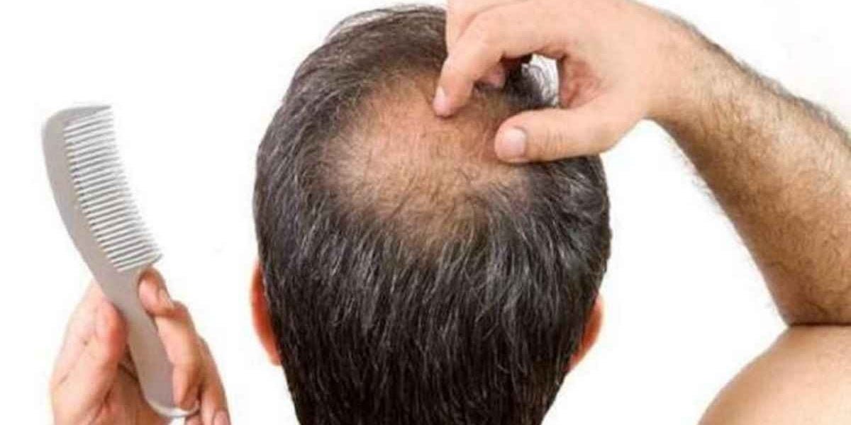 Hair Fall Treatment: इस तरह से आप झड़ते बालों से पा सकते हैं छुटकारा
