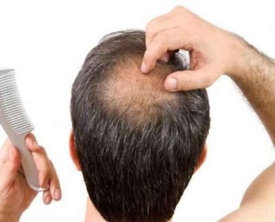 Hair Fall Treatment: इस तरह से आप झड़ते बालों से पा सकते हैं छुटकारा