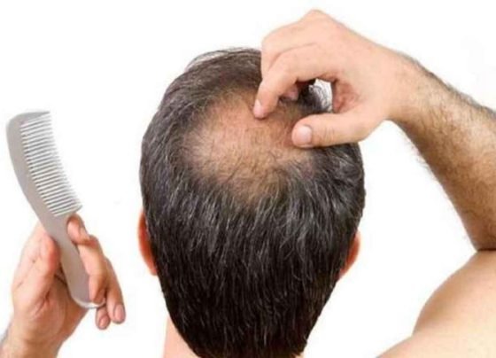 Hair Fall Treatment: इस तरह से आप झड़ते बालों से पा सकते हैं छुटकारा