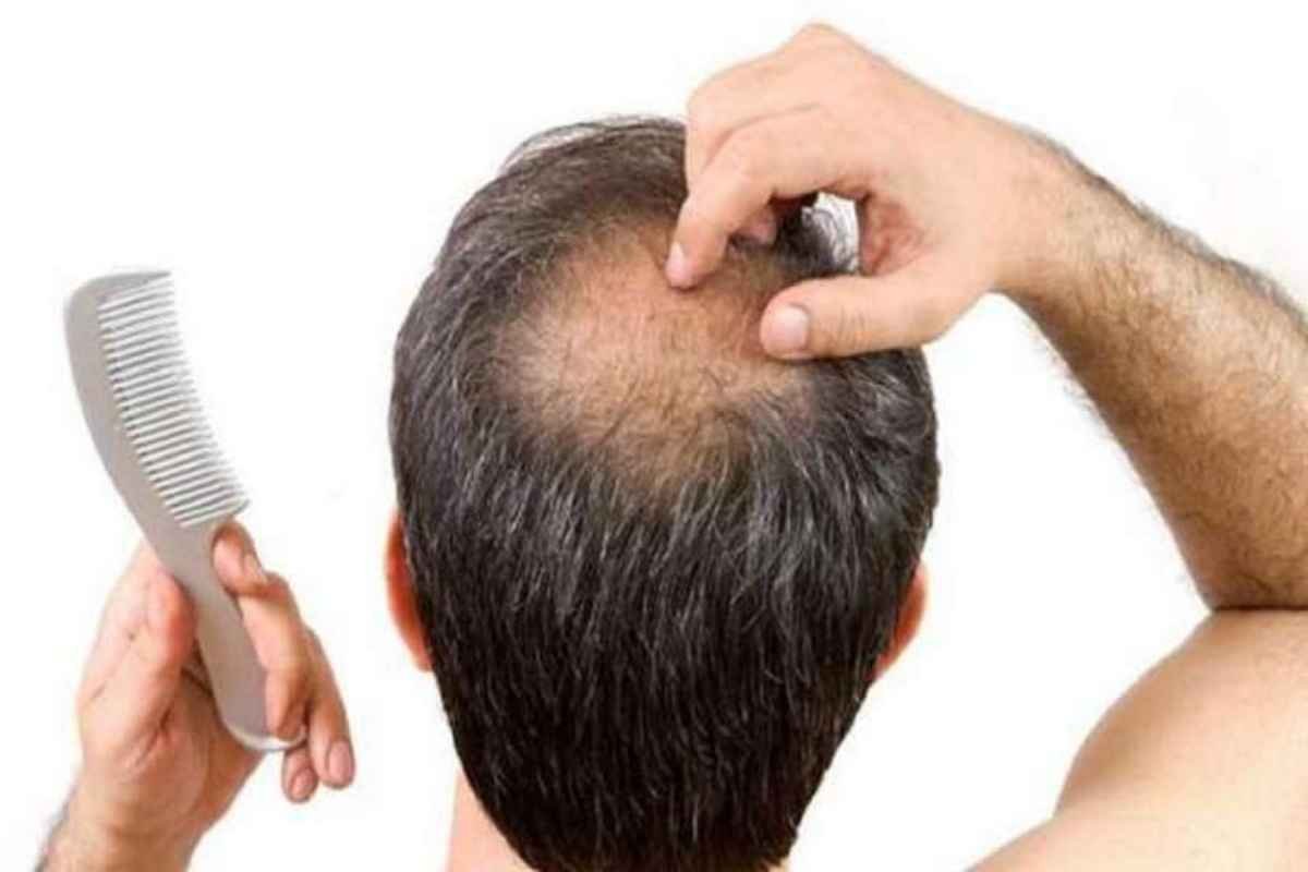 Hair Fall Treatment: क्या आप भी हो रहे हैं गंजेपन का शिकार, इन आसान टिप्स की मदद से बाल झड़ने से पा सकते हैं छुटकारा